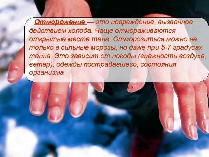 Отморожение — это повреждение, вызванное действием холода. Чаще отмораживаются открытые места тела. Отморозиться можно