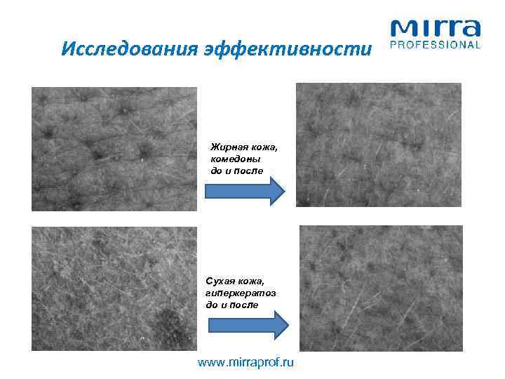 Исследования эффективности Жирная кожа, комедоны до и после Сухая кожа, гиперкератоз до и после