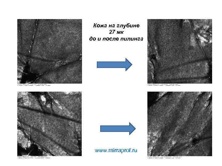 Кожа на глубине 27 мк до и после пилинга www. mirraprof. ru 