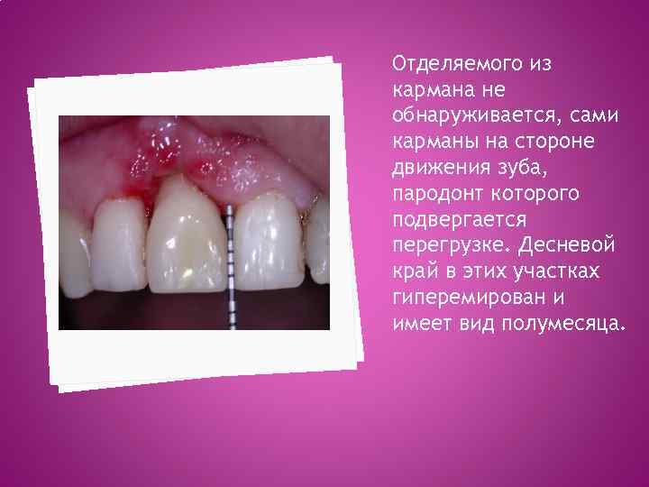 Отделяемого из кармана не обнаруживается, сами карманы на стороне движения зуба, пародонт которого подвергается