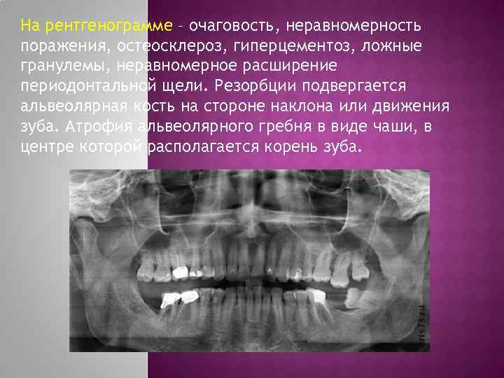 На рентгенограмме – очаговость, неравномерность поражения, остеосклероз, гиперцементоз, ложные гранулемы, неравномерное расширение периодонтальной щели.