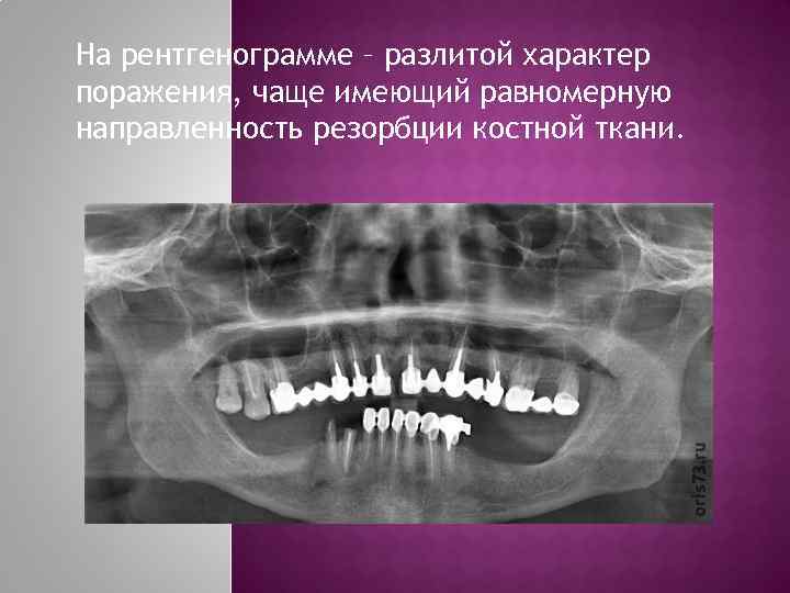 На рентгенограмме – разлитой характер поражения, чаще имеющий равномерную направленность резорбции костной ткани. 