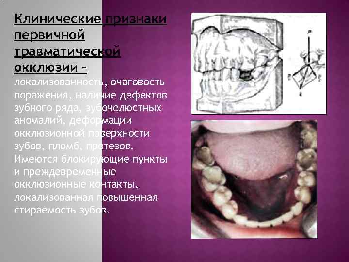 Клинические признаки первичной травматической окклюзии – локализованность, очаговость поражения, наличие дефектов зубного ряда, зубочелюстных