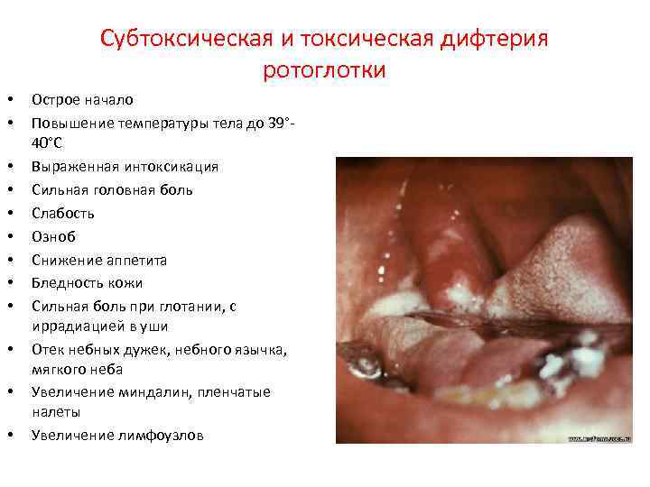 Субтоксическая и токсическая дифтерия ротоглотки • • • Острое начало Повышение температуры тела до