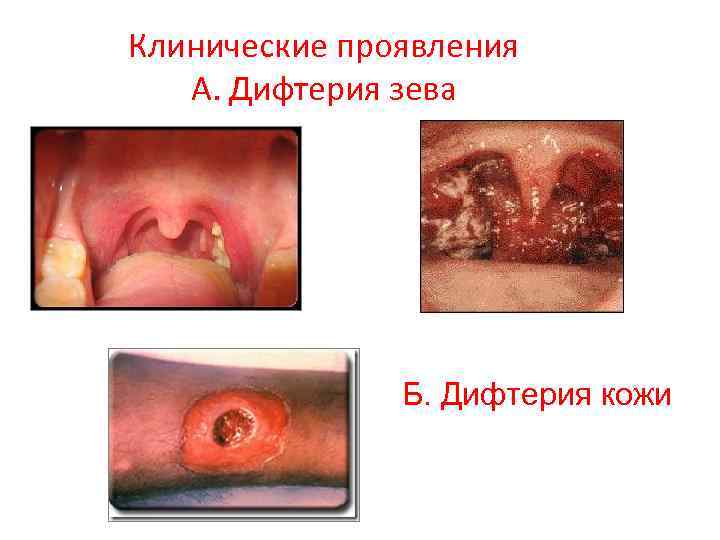 Клинические проявления А. Дифтерия зева Б. Дифтерия кожи 