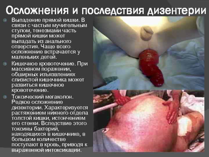 Осложнения и последствия дизентерии Выпадение прямой кишки. В связи с частым мучительным стулом, тенезмами
