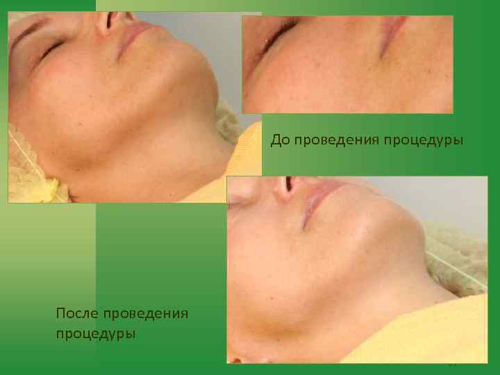 До проведения процедуры После проведения процедуры 81 