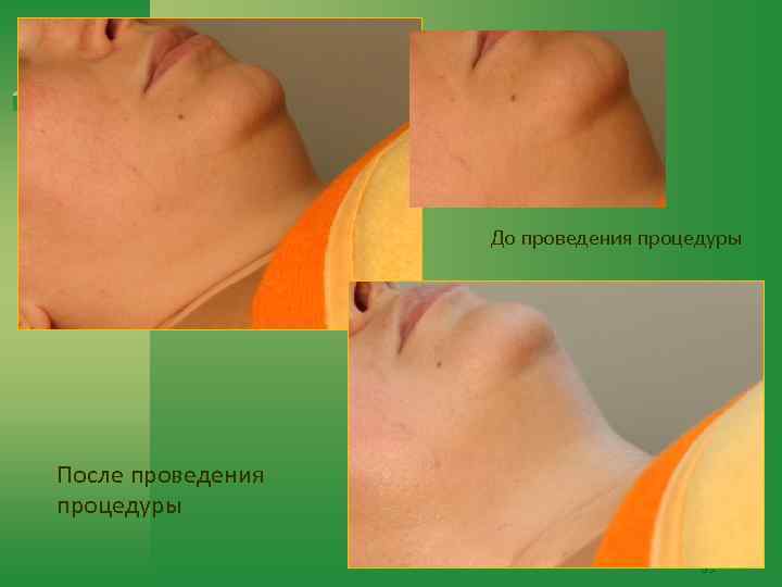 До проведения процедуры После проведения процедуры 83 