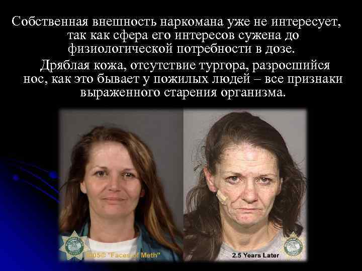 Собственная внешность наркомана уже не интересует, так как сфера его интересов сужена до физиологической