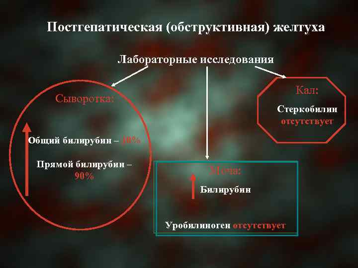 Постгепатическая (обструктивная) желтуха Лабораторные исследования Кал: Сыворотка: Стеркобилин отсутствует Общий билирубин – 10% Прямой