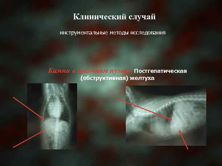 Клинический случай инструментальные методы исследования Камни в желчном пузыре Постгепатическая (обструктивная) желтуха 