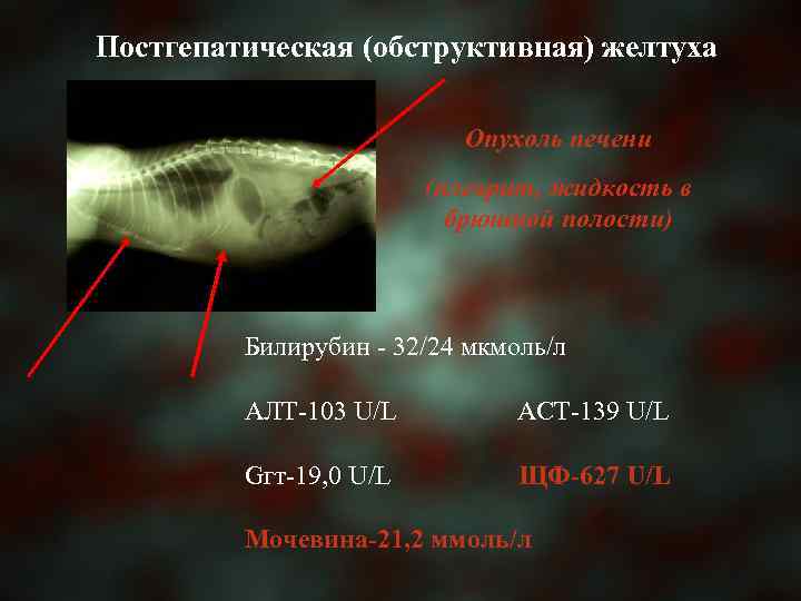 Постгепатическая (обструктивная) желтуха Опухоль печени (плеврит, жидкость в брюшной полости) Билирубин - 32/24 мкмоль/л