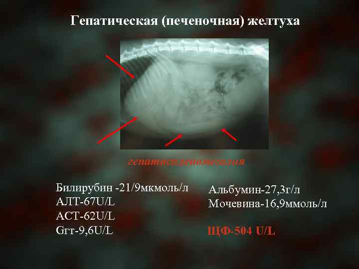 Гепатическая (печеночная) желтуха гепатоспленомегалия Билирубин -21/9 мкмоль/л АЛТ-67 U/L АСТ-62 U/L Gгт-9, 6 U/L