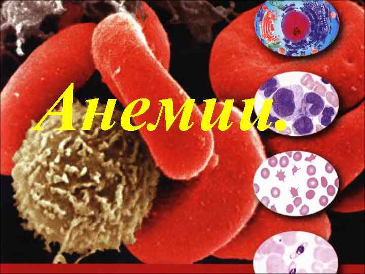 Анемии. 