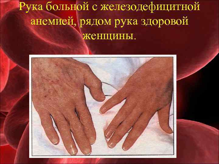 Рука больной с железодефицитной анемией, рядом рука здоровой женщины. 