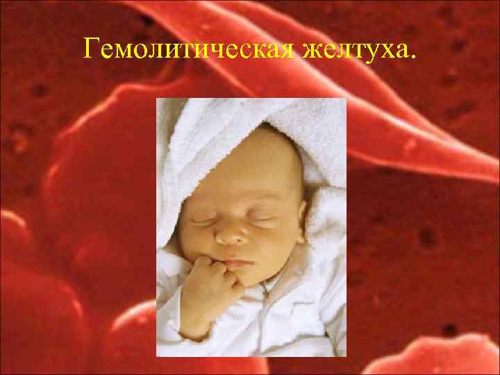 Гемолитическая желтуха. 