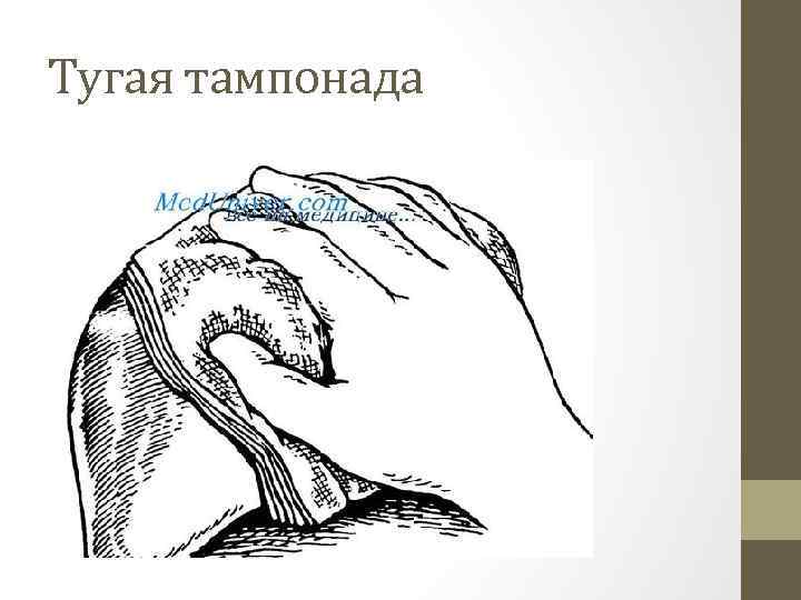 Тугая тампонада 