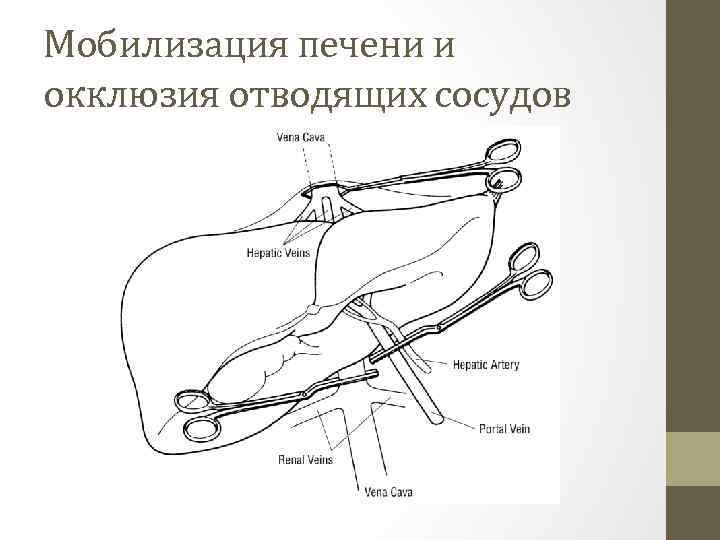 Мобилизация печени и окклюзия отводящих сосудов 