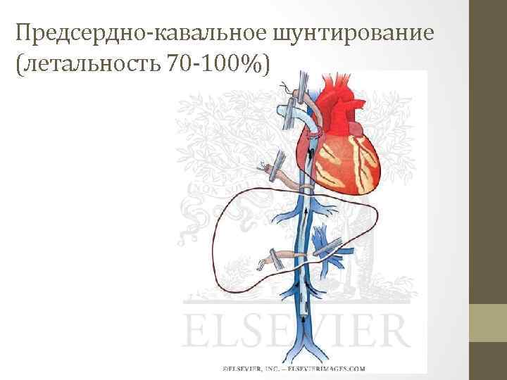 Предсердно-кавальное шунтирование (летальность 70 -100%) 