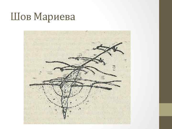 Шов Мариева 