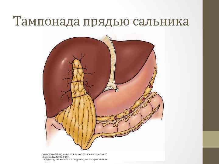 Тампонада прядью сальника 