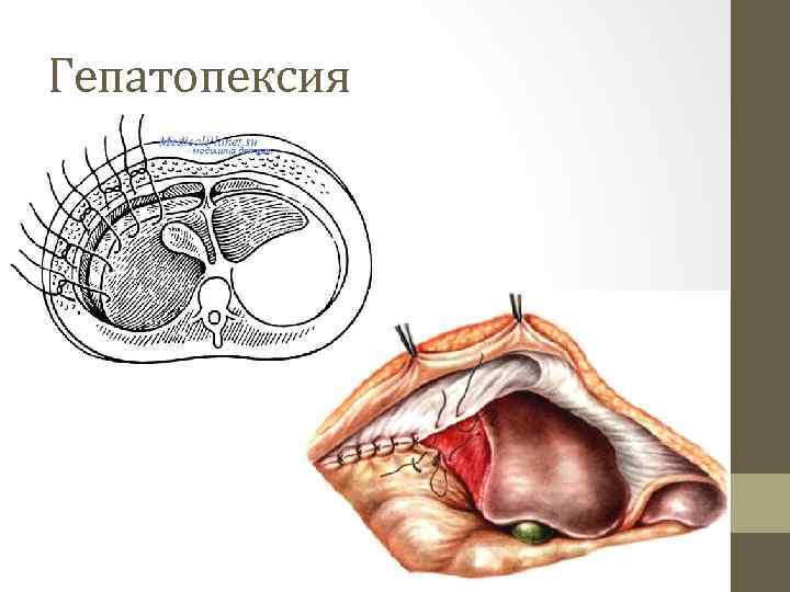 Гепатопексия 