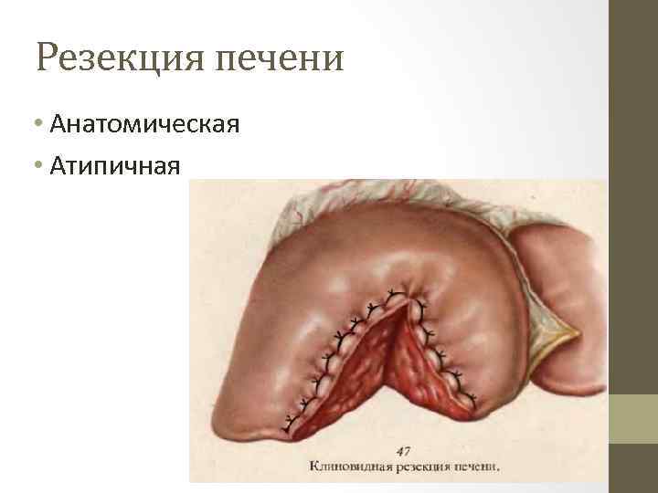 Резекция печени • Анатомическая • Атипичная 