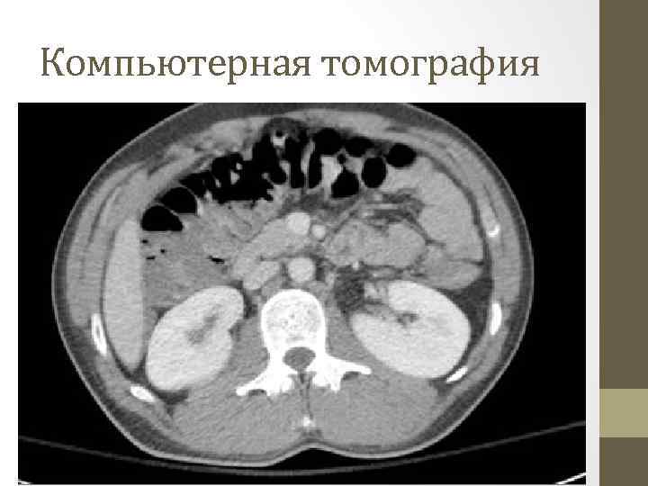 Компьютерная томография 