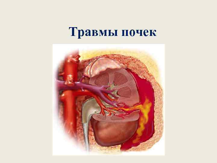 Травмы почек 