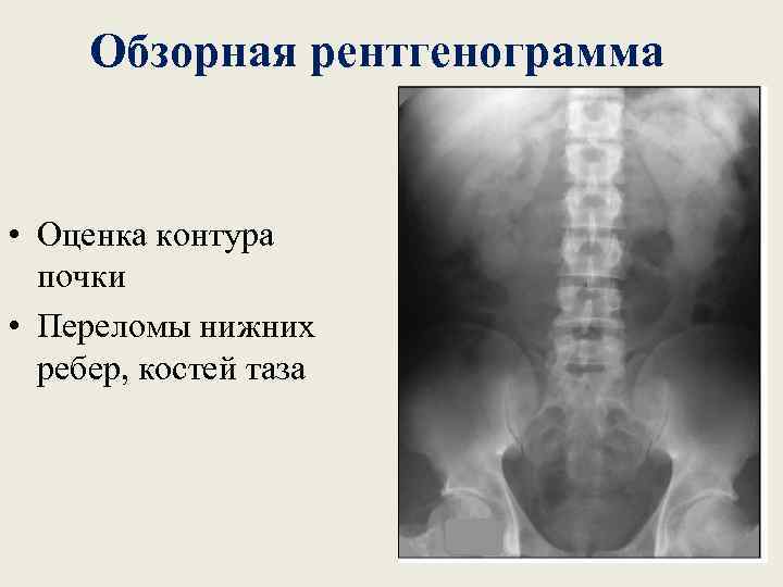 Обзорная рентгенограмма • Оценка контура почки • Переломы нижних ребер, костей таза 
