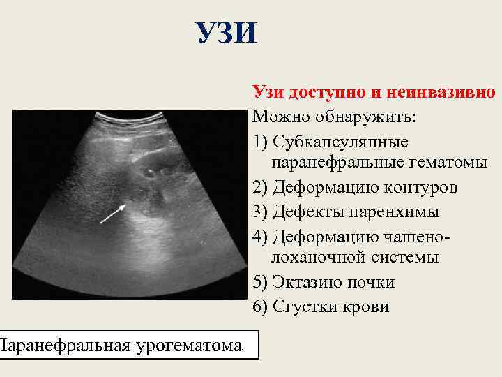 УЗИ Паранефральная урогематома Узи доступно и неинвазивно Можно обнаружить: 1) Cубкапсуляпные паранефральные гематомы 2)