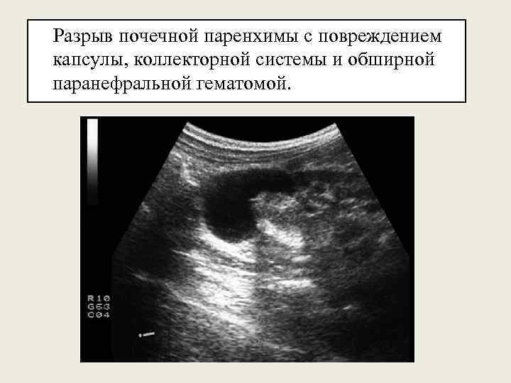 Разрыв почечной паренхимы с повреждением капсулы, коллекторной системы и обширной паранефральной гематомой. 
