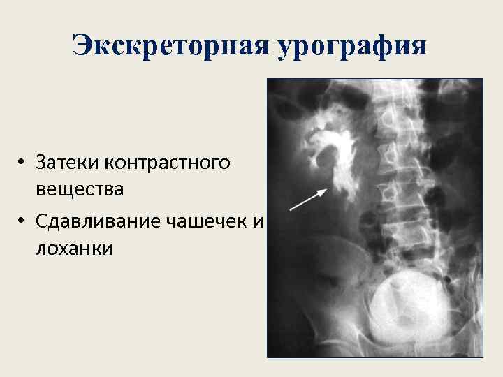 Экскреторная урография • Затеки контрастного вещества • Сдавливание чашечек и лоханки 
