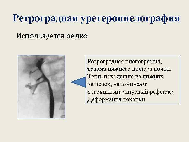 Ретроградная уретеропиелография Используется редко Ретроградная пиелограмма, травма нижнего полюса почки. Тени, исходящие из нижних