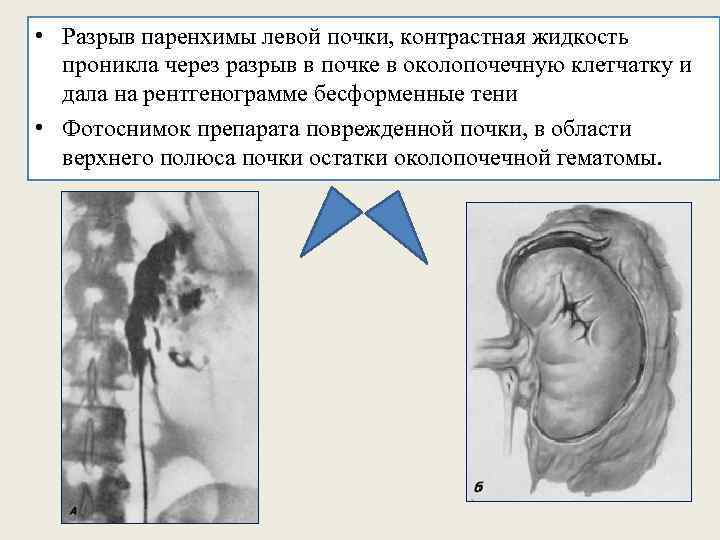  • Разрыв паренхимы левой почки, контрастная жидкость проникла через разрыв в почке в