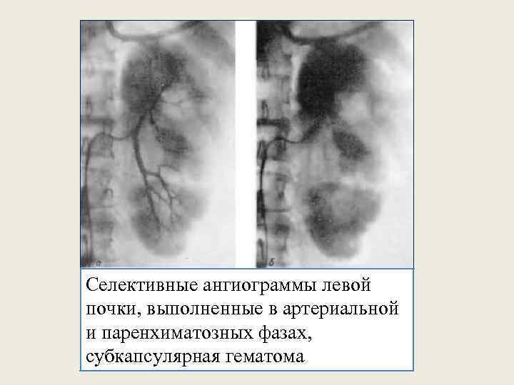 Селективные ангиограммы левой почки, выполненные в артериальной и паренхиматозных фазах, субкапсулярная гематома 