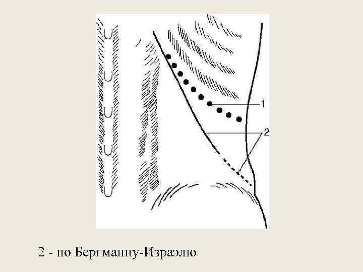 2 - по Бергманну-Израэлю 