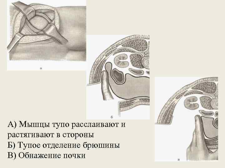 А) Мышцы тупо расслаивают и растягивают в стороны Б) Тупое отделение брюшины В) Обнажение
