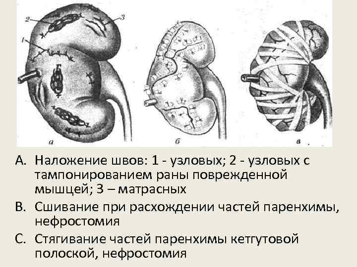 A. Наложение швов: 1 - узловых; 2 - узловых с тампонированием раны поврежденной мышцей;