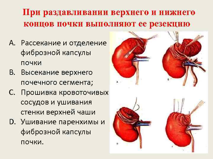 При раздавливании верхнего и нижнего концов почки выполняют ее резекцию A. Рассекание и отделение