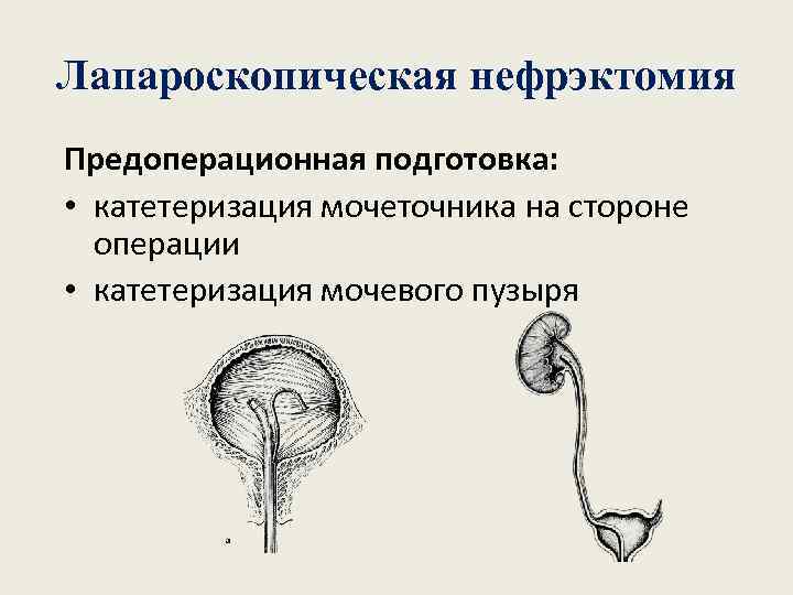 Лапароскопическая нефрэктомия Предоперационная подготовка: • катетеризация мочеточника на стороне операции • катетеризация мочевого пузыря