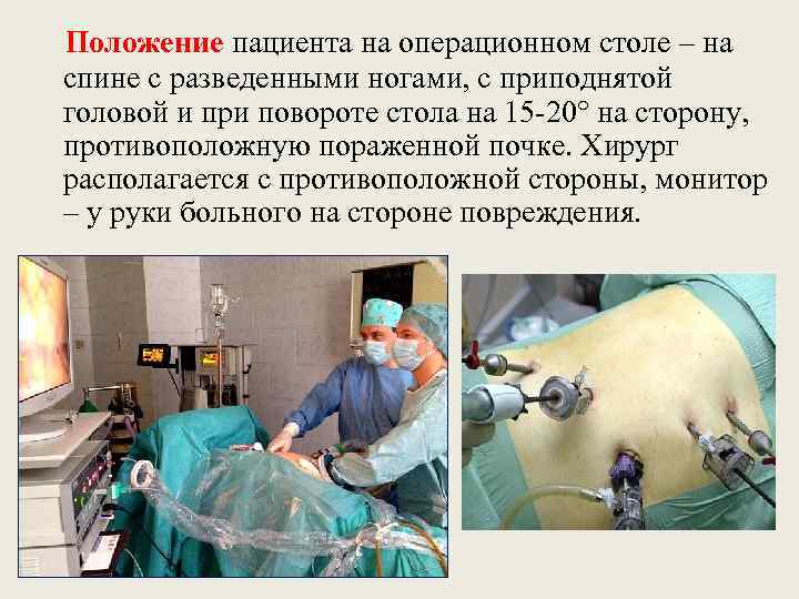 Положение пациента на операционном столе – на спине с разведенными ногами, с приподнятой головой