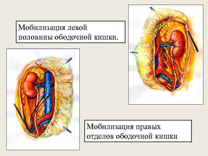 Мобилизация левой половины ободочной кишки. Мобилизация правых отделов ободочной кишки 