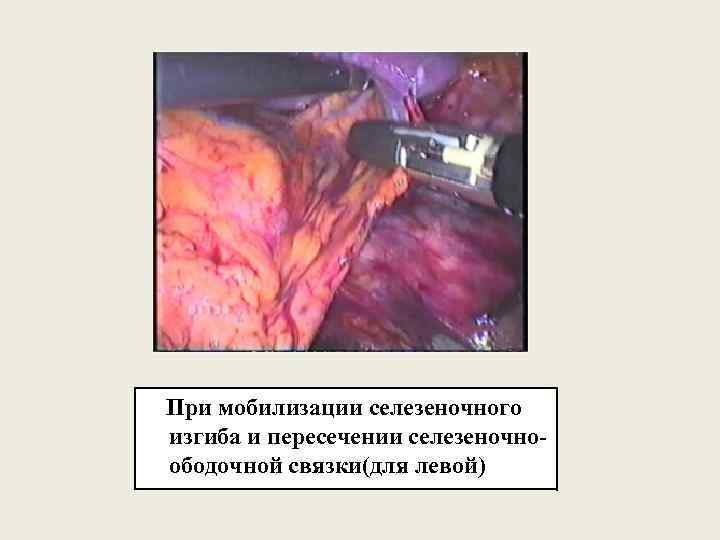 При мобилизации селезеночного изгиба и пересечении селезеночноободочной связки(для левой) 