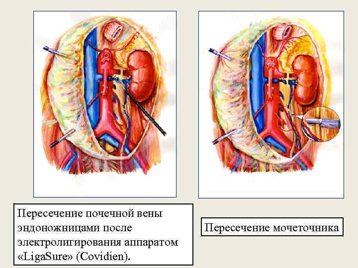 Пересечение почечной вены эндоножницами после электролигирования аппаратом «Liga. Sure» (Covidien). Пересечение мочеточника 