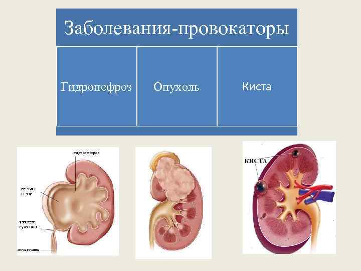 Заболевания-провокаторы Гидронефроз Опухоль Киста 