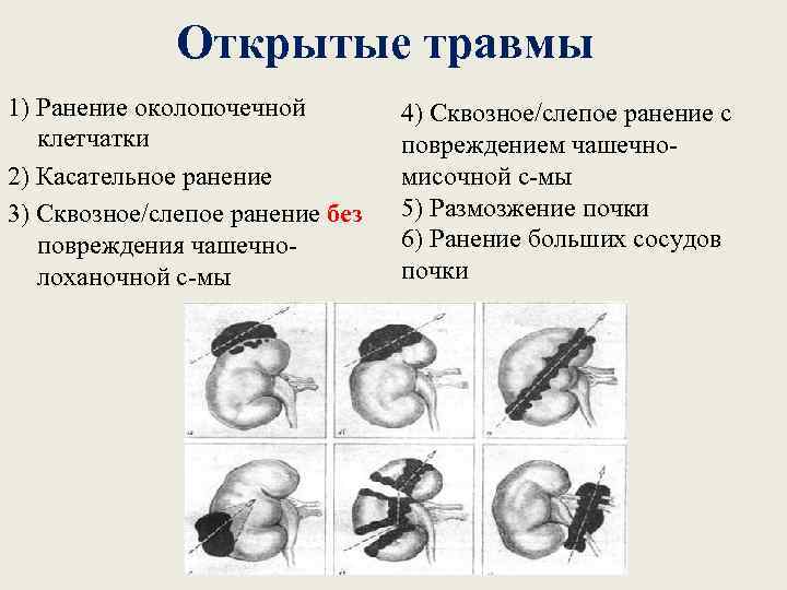 Открытые травмы 1) Ранение околопочечной клетчатки 2) Касательное ранение 3) Сквозное/слепое ранение без повреждения