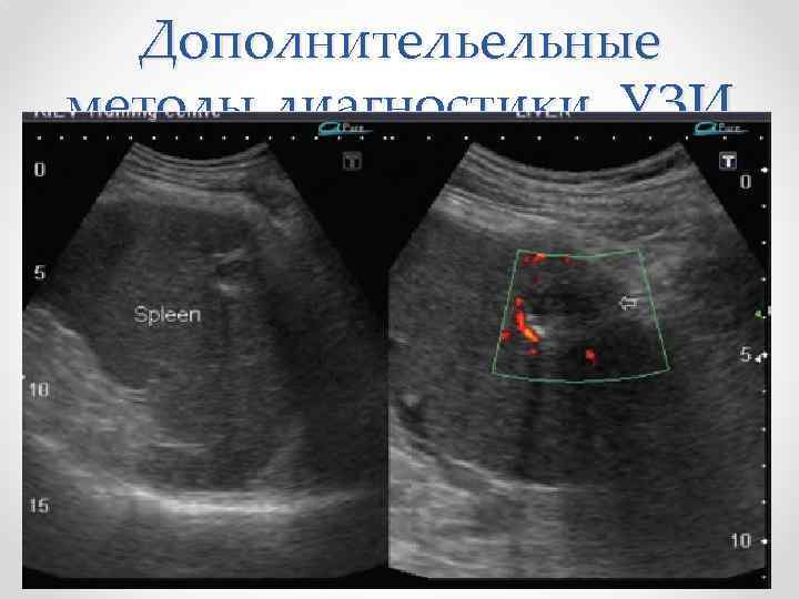 Дополнительельные методы диагностики. УЗИ 