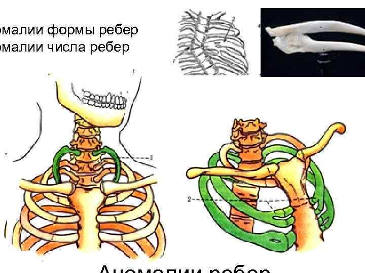 омалии формы ребер омалии числа ребер 