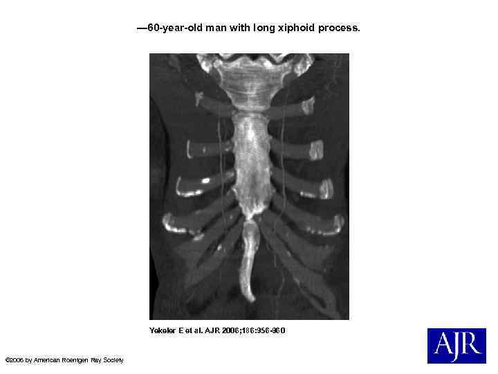 — 60 -year-old man with long xiphoid process. Yekeler E et al. AJR 2006;